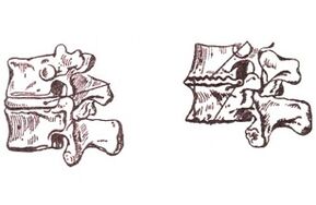 Etapas de desenvolvemento da toraxosteocondrose