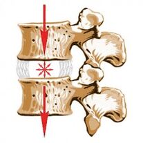 O dispositivo da columna vertebral e as causas da osteocondrose