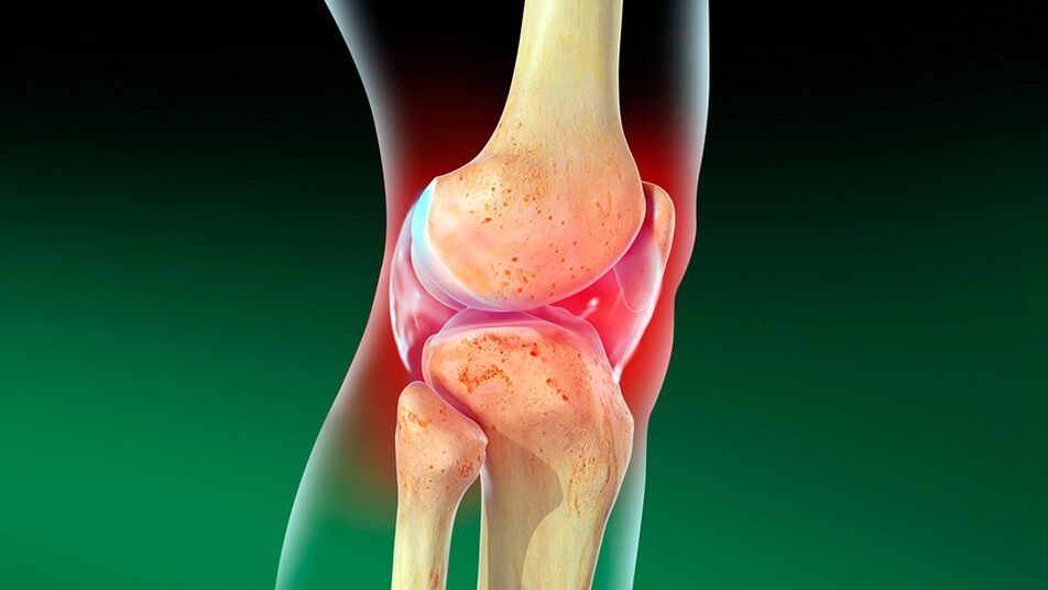 Osteoartrite da articulación do xeonllo
