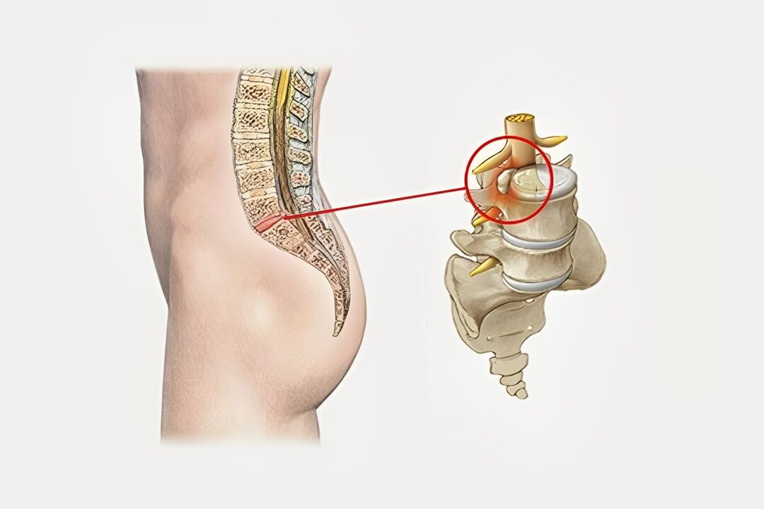 Deformación do disco intervertebral na columna vertebral sacra