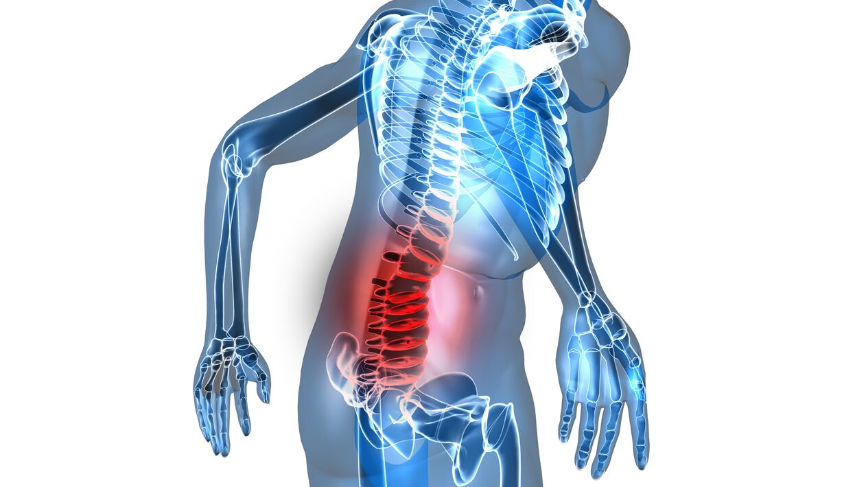 Osteocondrose da columna lumbar